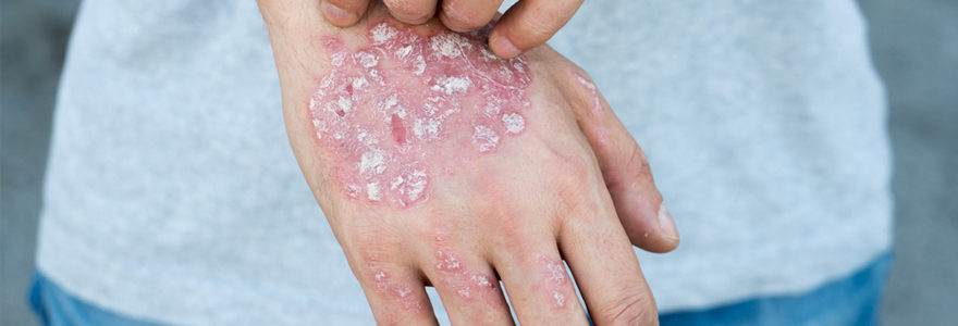 Quels remèdes naturels pour traiter le psoriasis